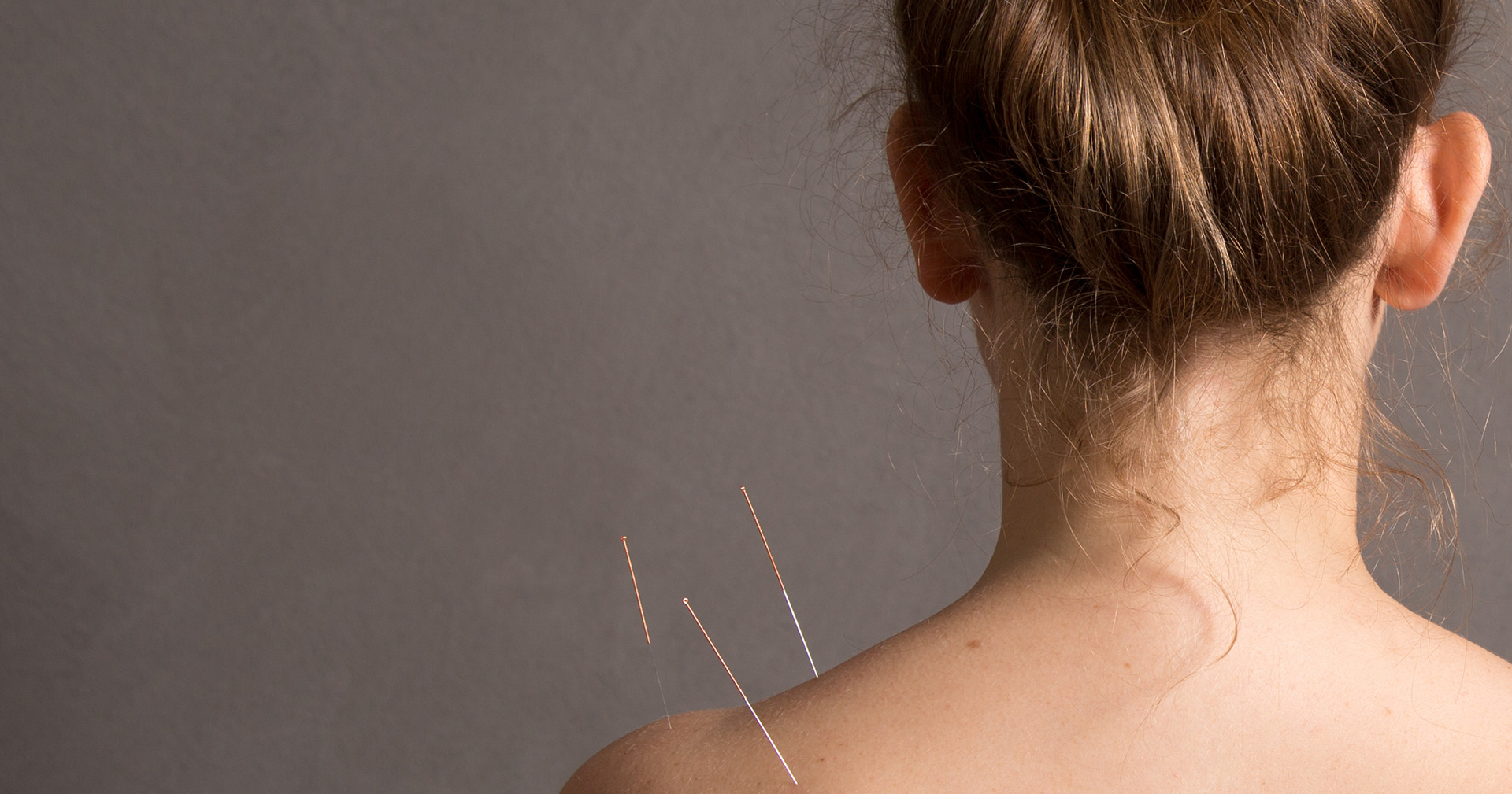 Acupunctuur behandeling